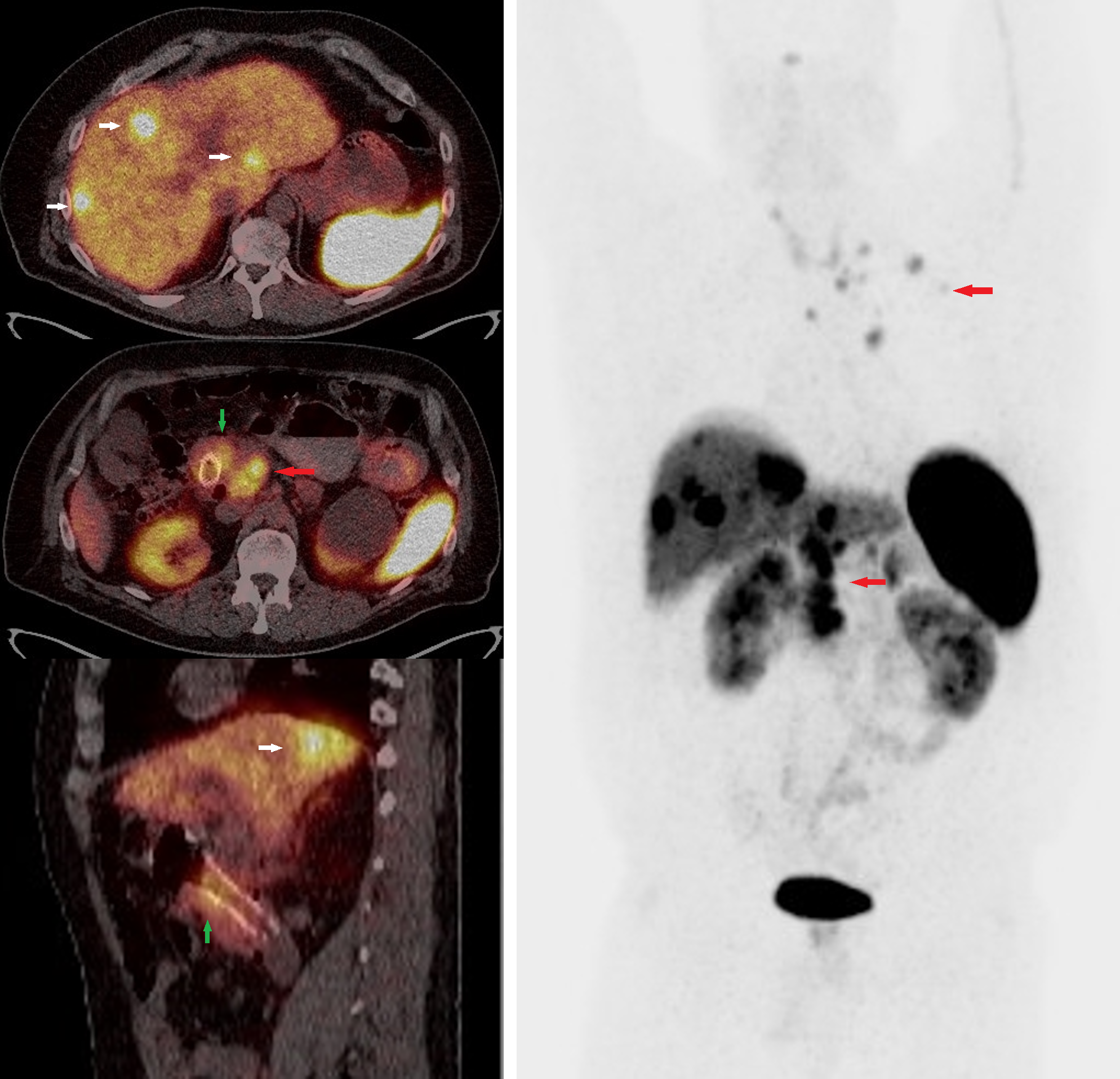 <p>Gastrointestinal Neuroendocrine Tumor on Advanced Nuclear Imaging