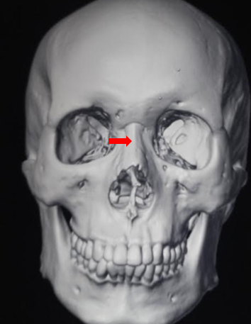 <p>Nasal Bones.</p>