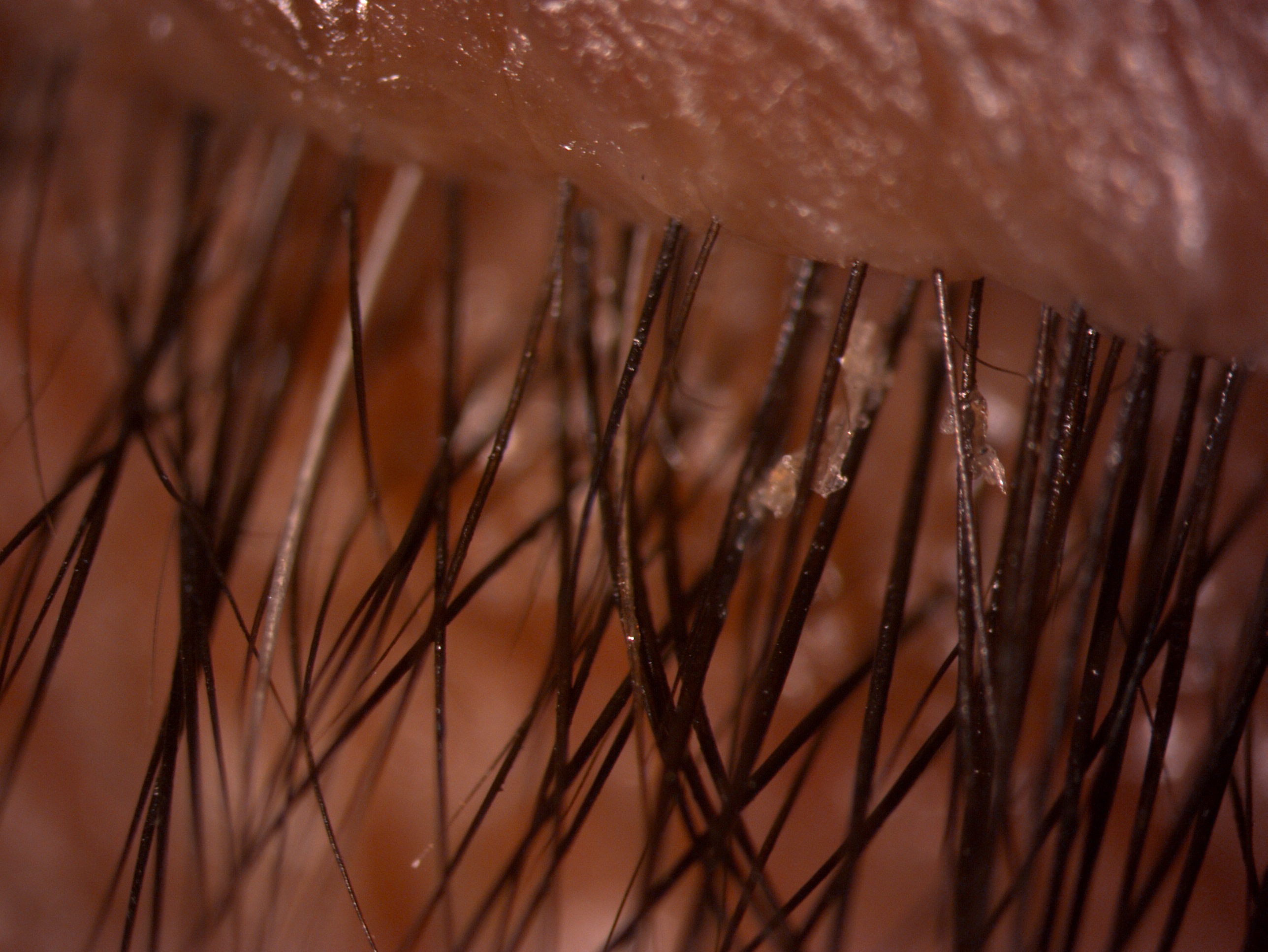 <p>Slit-Lamp View of Blepharitis With Eyelid Crusting
