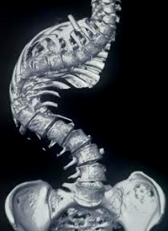 <p>Scoliosis, Spine.</p>