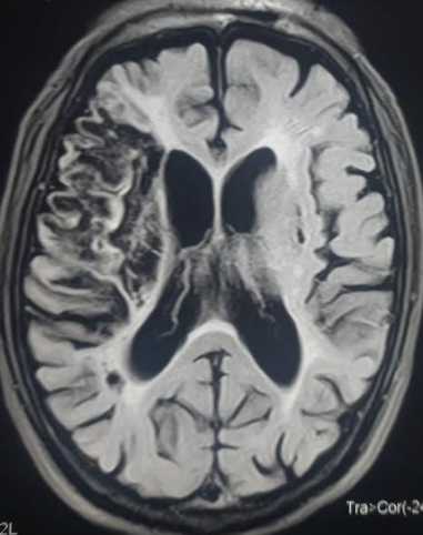 <p>Encephalomalacia Following Ischemic Stroke.</p>