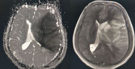 <p>Left Middle Cerebral Artery Territory Infarction.</p>