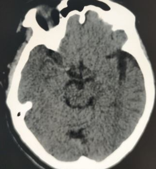 <p>Right Middle Cerebral Artery "Cord Sign" Indicative of Acute Infarction.</p>