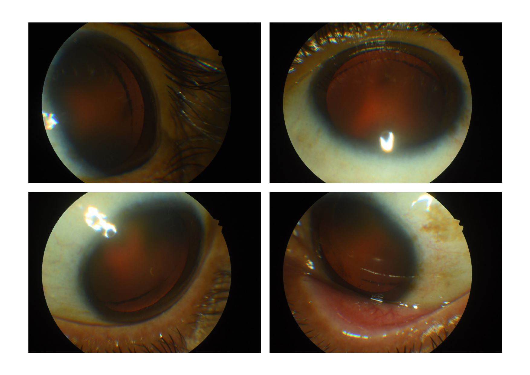 Zentmayer line (Schie line) in an eye with pigment dispersion syndrome