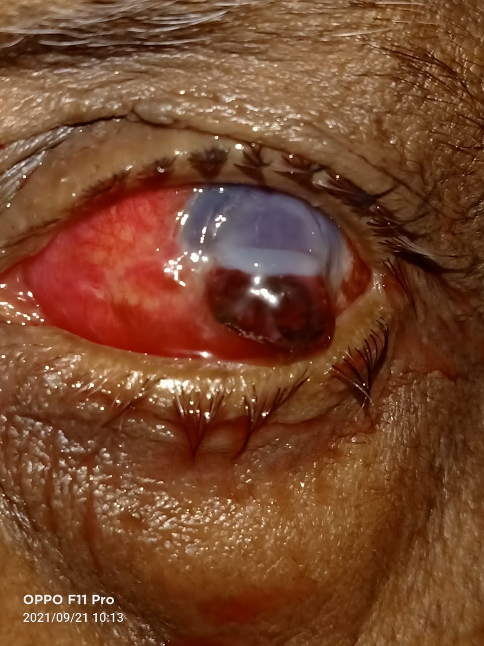 Digital image of the patient depicting inferior limbal laceration with prolapse of uveal tissue post iron nail injury