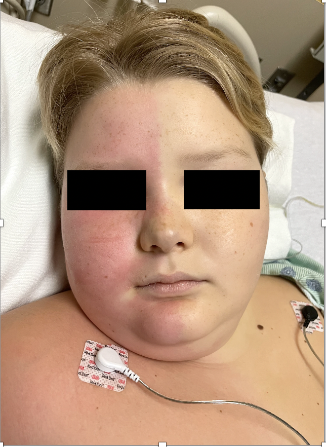 Figure 1: Harlequin syndrome; Unilateral facial flushing sharply demarcated in the midline from the contralateral pallor