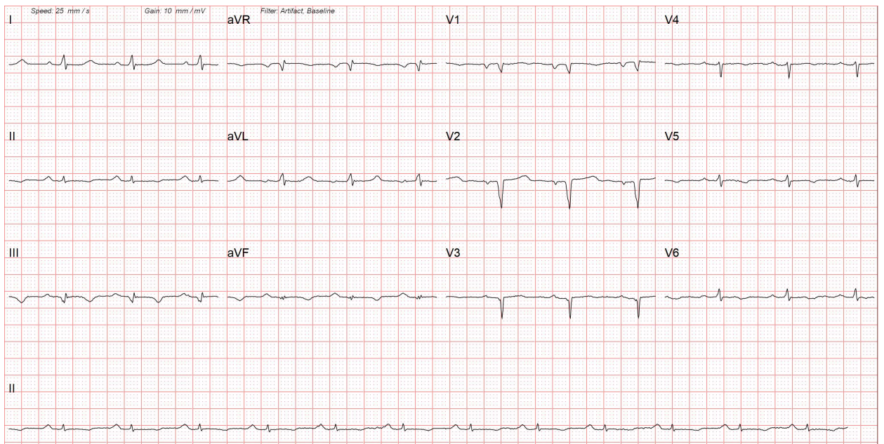 <p>Cardiac Amyloidosis on&nbsp;Electrocardiography