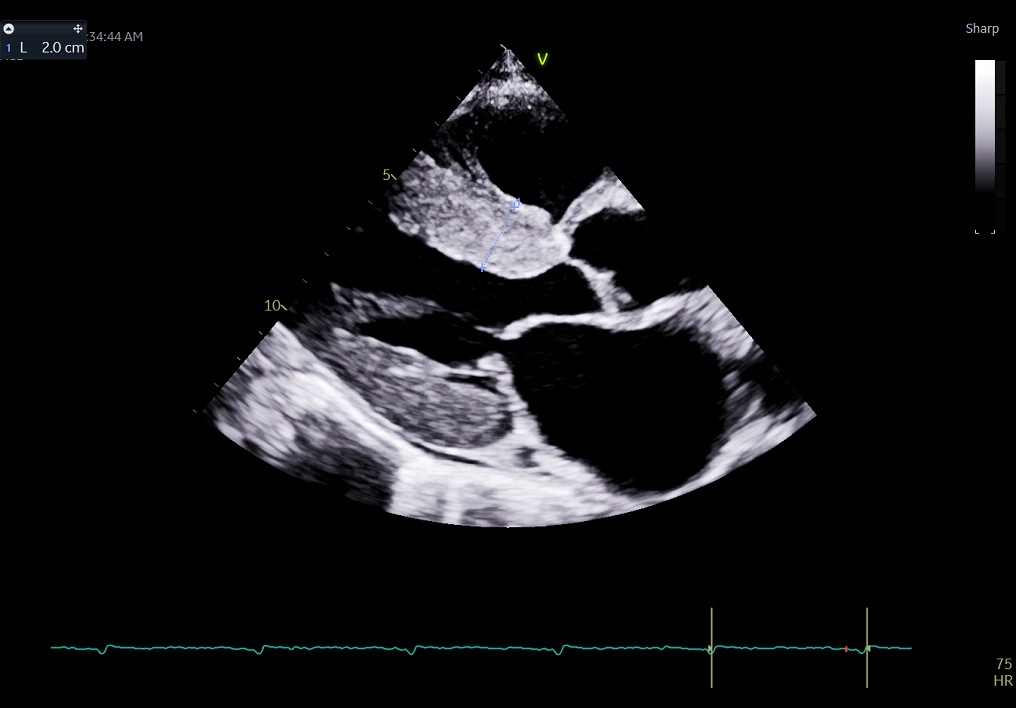 <p>Cardiac Amyloidosis on&nbsp;Transthoracic Echocardiogram
