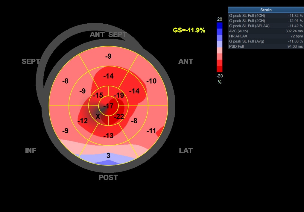 <p>Global Longitudinal Strain Analysis for Cardiac Amyloidosis