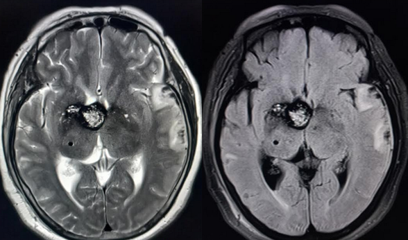 <p>Third Ventricular Cavernoma