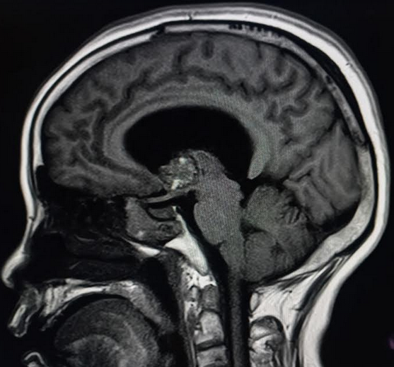 <p>Third Ventricular Cavernoma, Sagittal View