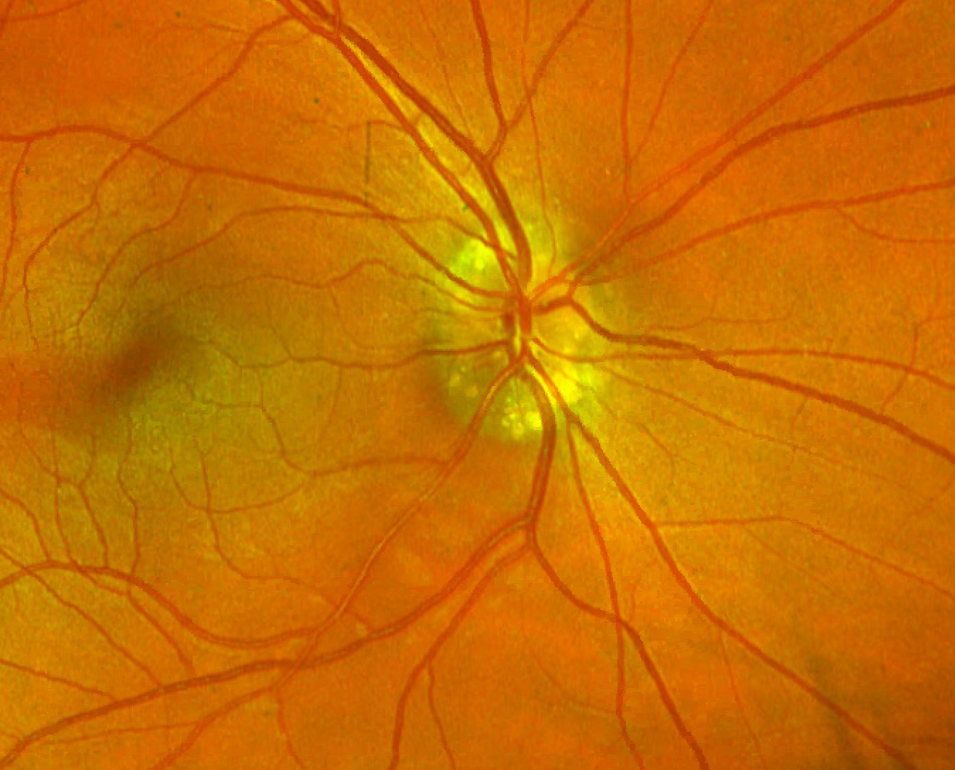 Fundus photo revealing pseudo papilledema from optic nerve head drusen