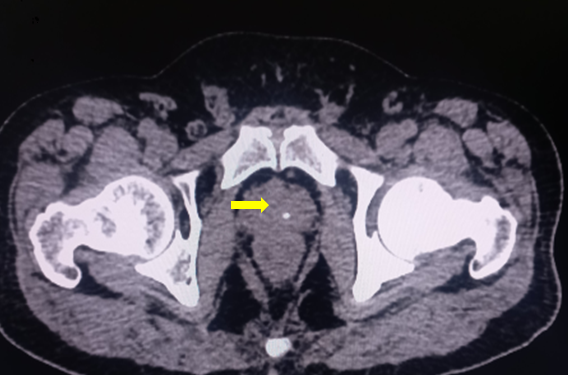 <p>Axial CT Scan of Pelvis Showing Prostate Gland. The yellow arrow indicates the location of the prostate gland.</p>