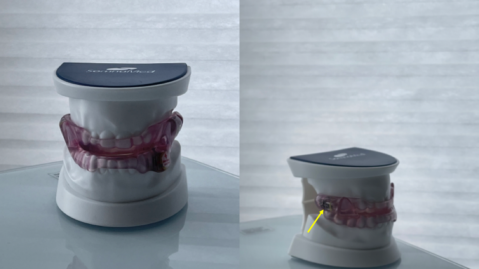 <p>Custom Oral Appliance for Upper Airway Resistance Syndrome