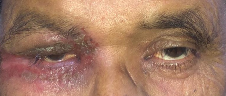 <p>Anterior Blepharitis</p>