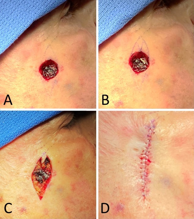 <p>M-Plasty Technique