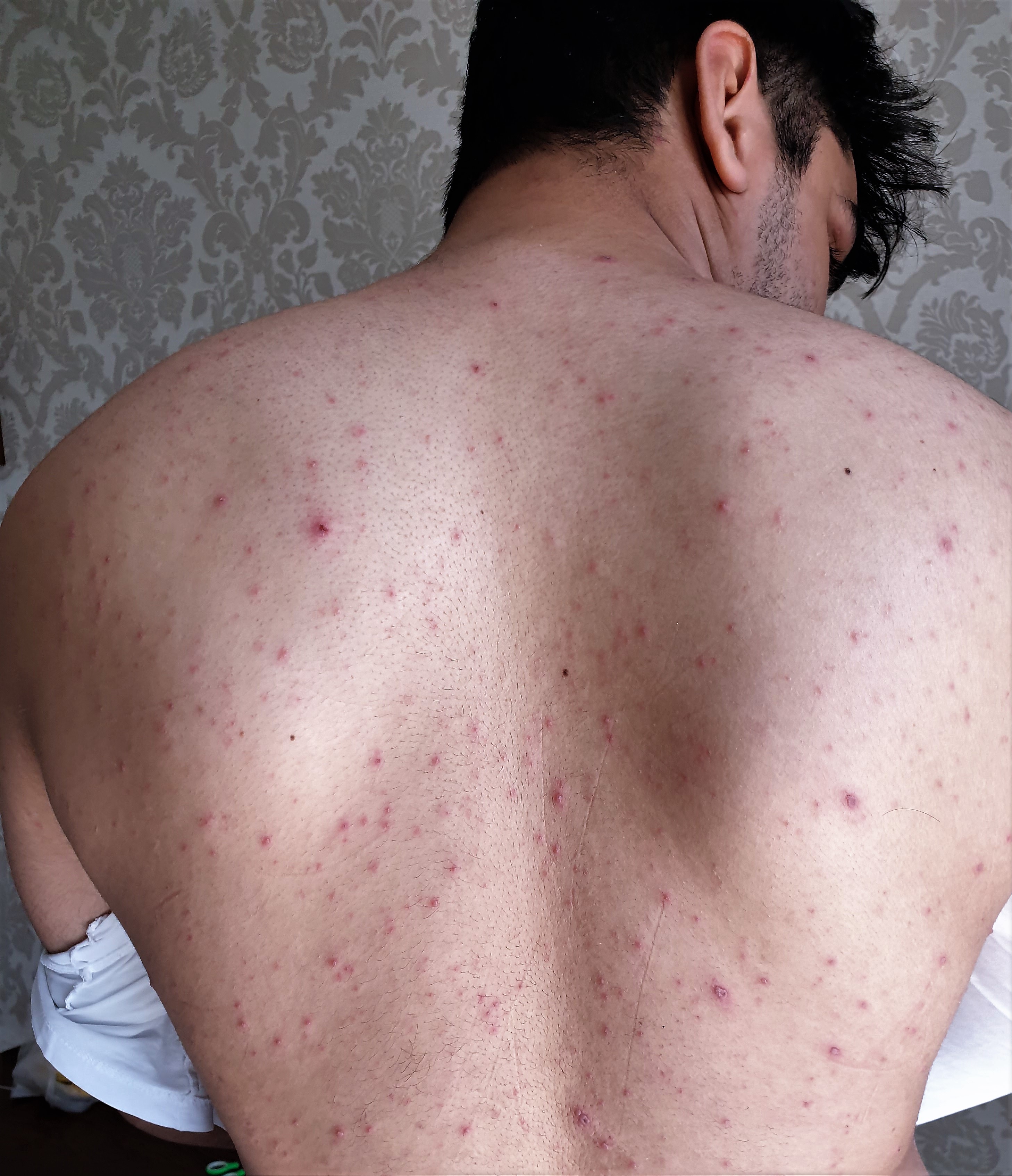 <p>Varicella Rash. Papules, pustules, and vesicles are seen on the back of a patient with chickenpox.</p>