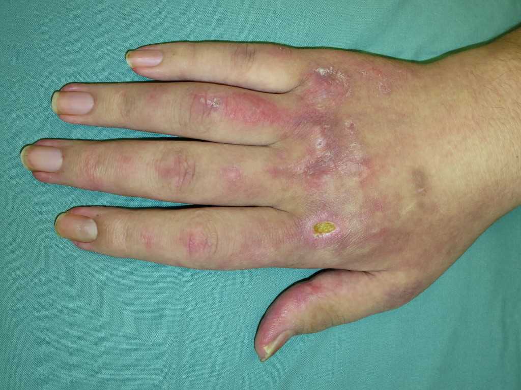 <p>Dermatomyositis</p>