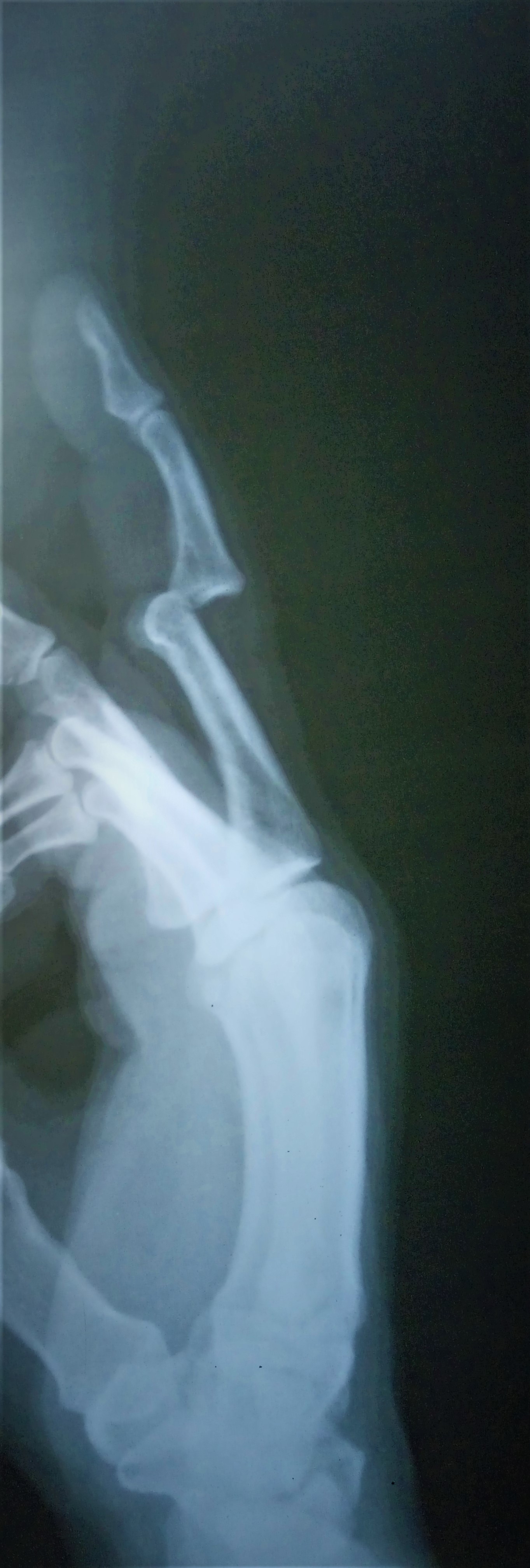 <p>Proximal Interphalangeal (PIP) Joint Dorsal Dislocation, Radiograph