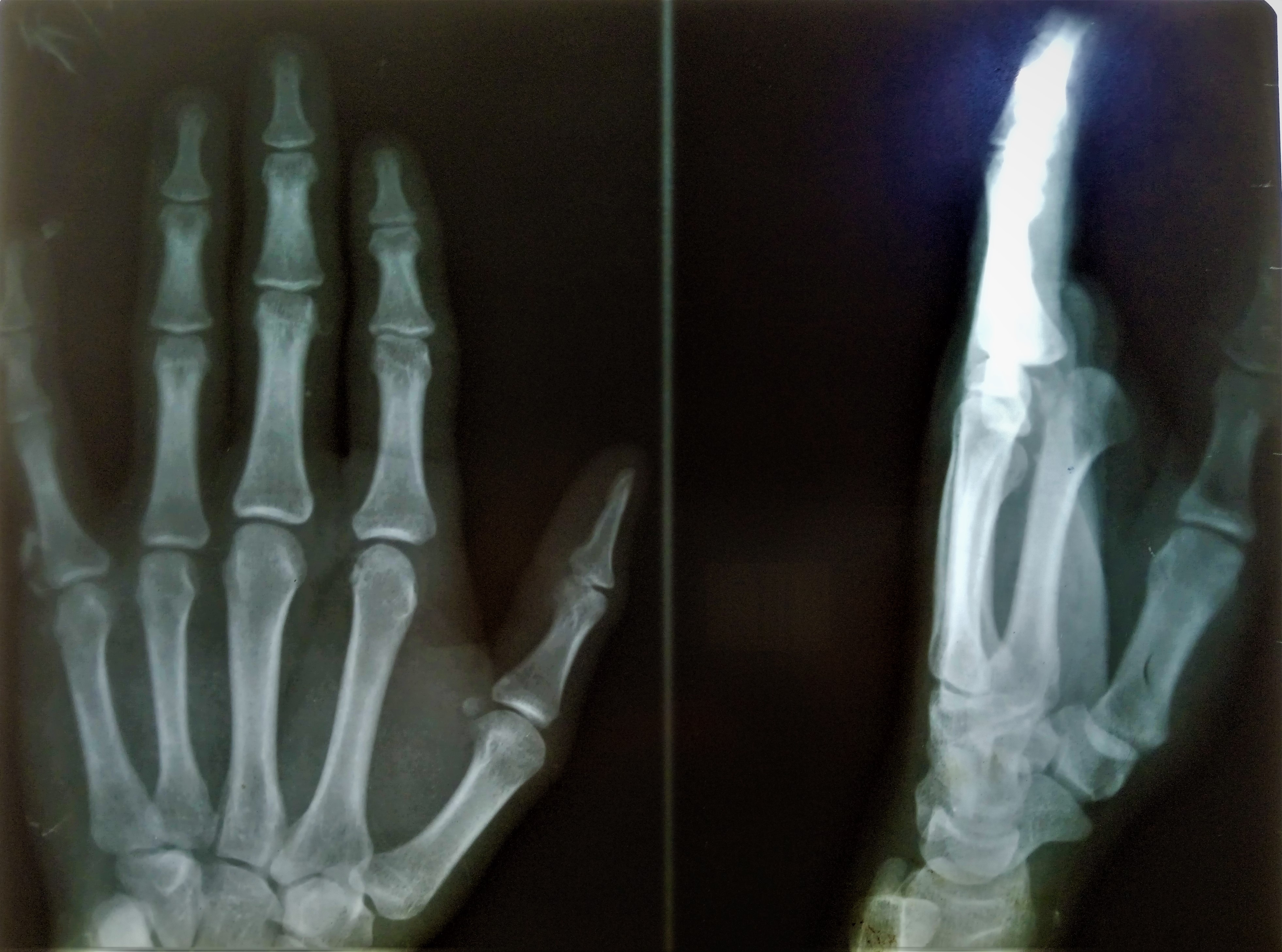 <p>Metacarpophalangeal (MCP) Joint Dorsal Dislocation, Radiograph