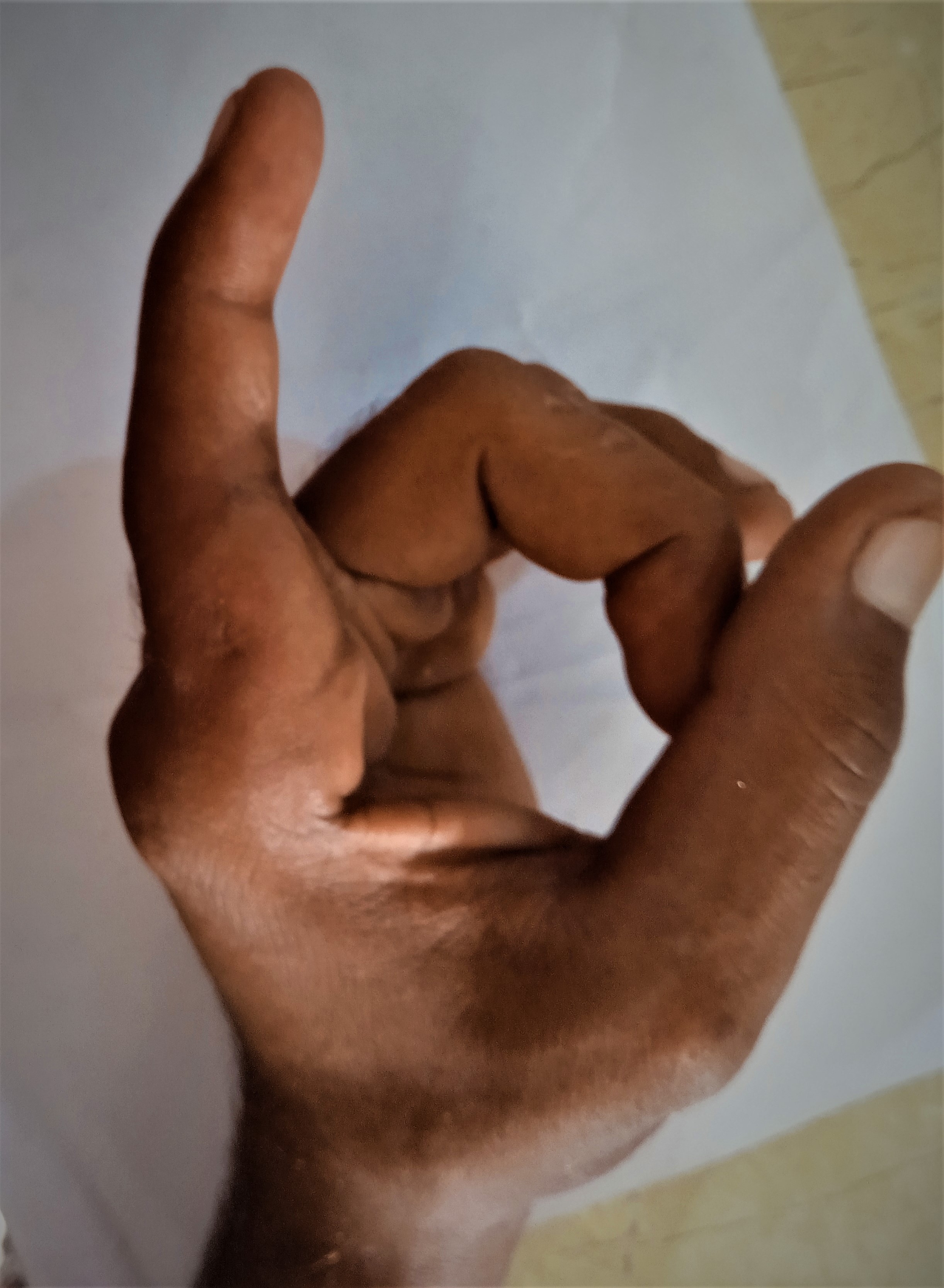 <p>First Metacarpophalangeal (MCP) Joint Dorsal Dislocation