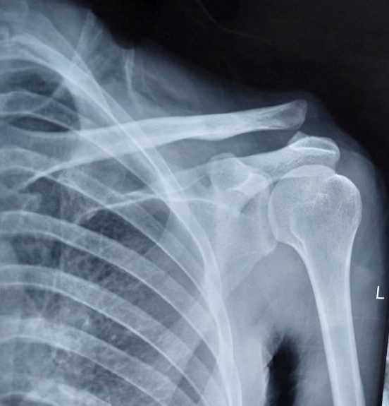 <p>Acromioclavicular Joint Disruption