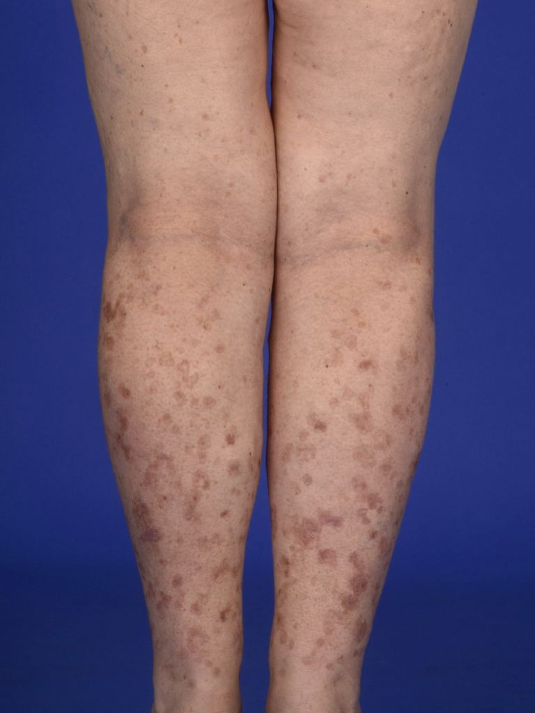 <p>Disseminated Superficial Actinic Porokeratosis