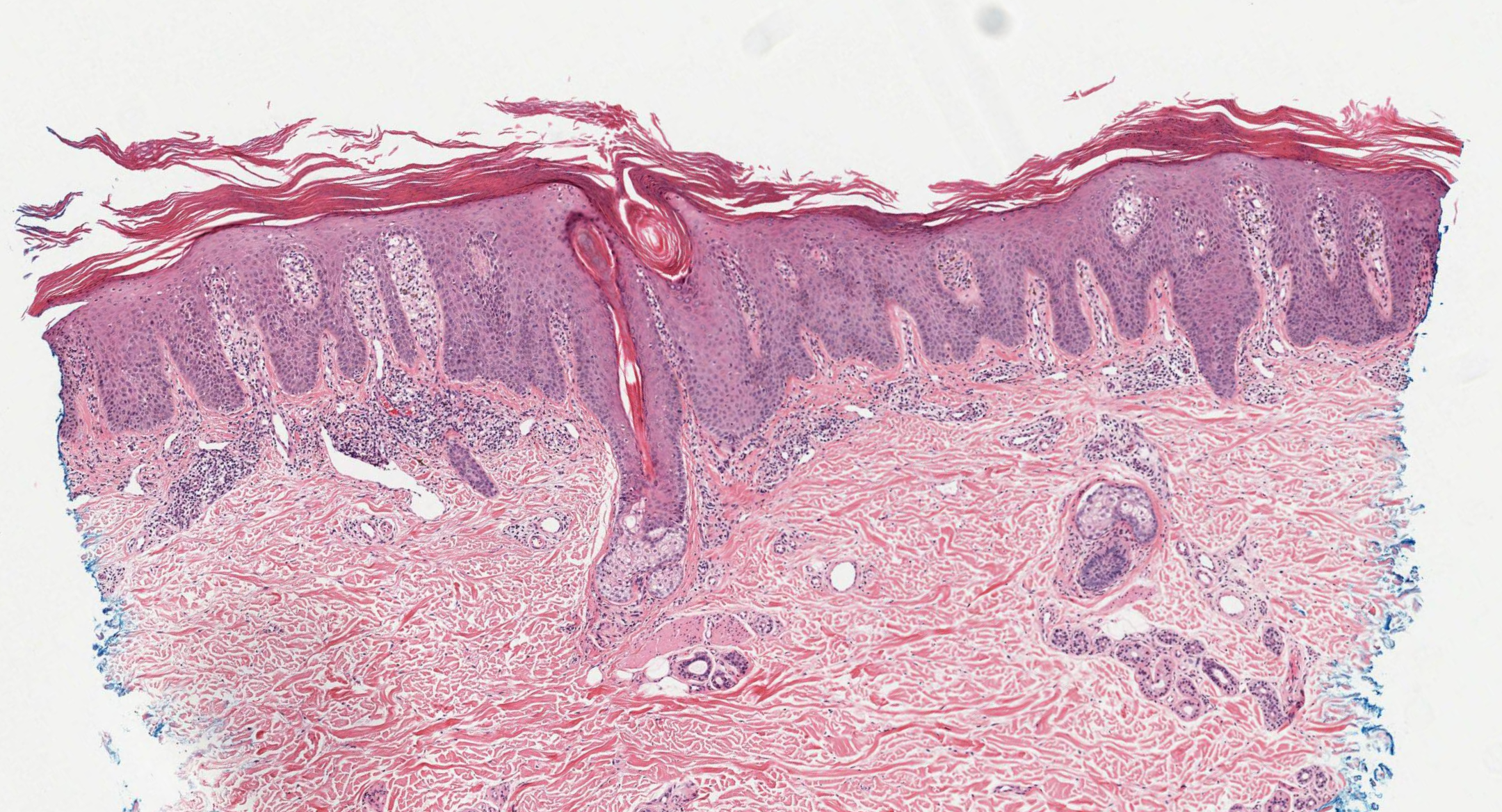 <p>Psoriasis Dermpath
