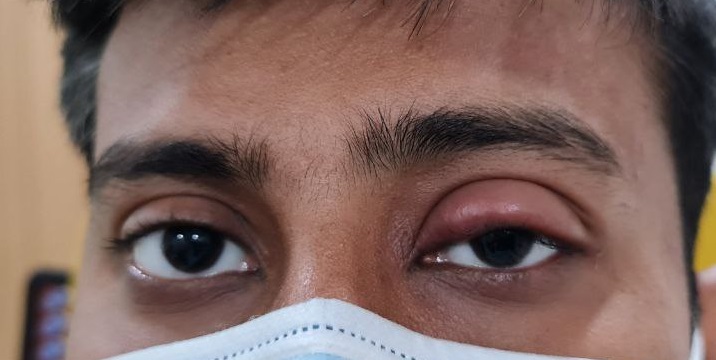 <p>Stye With Periorbital Cellulitis.</p>