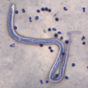 Microfilaria of Wuchereria bancrofti is seen in this thick blood smear stained with Giemsa.