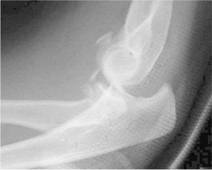 <p>Terrible Triad Injury on Lateral Elbow Radiography