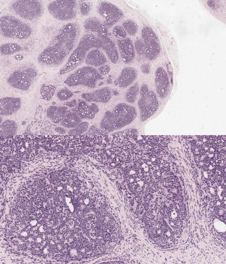 <p>Trichoblastoma