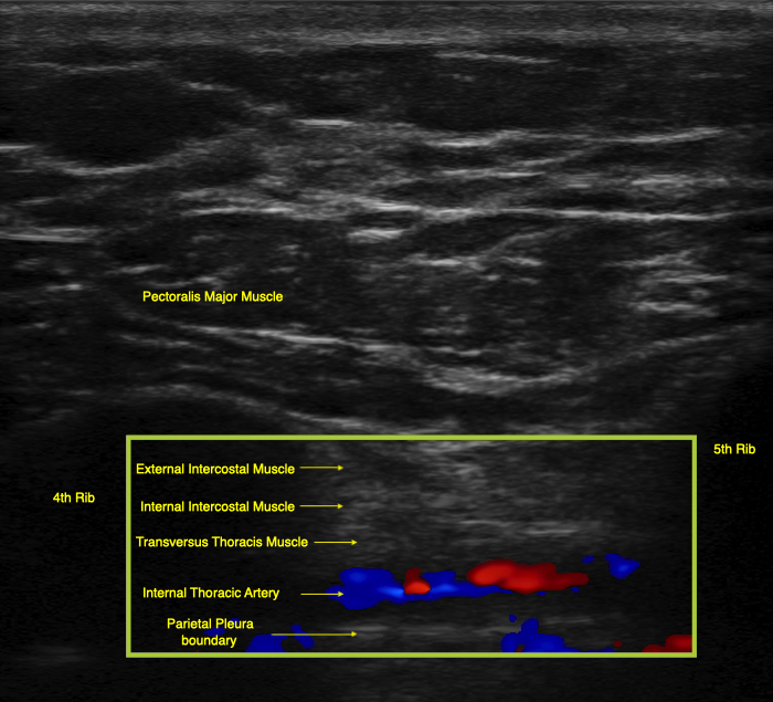 The internal thoracic artery lies in the same plane as the transversus thoracis muscle