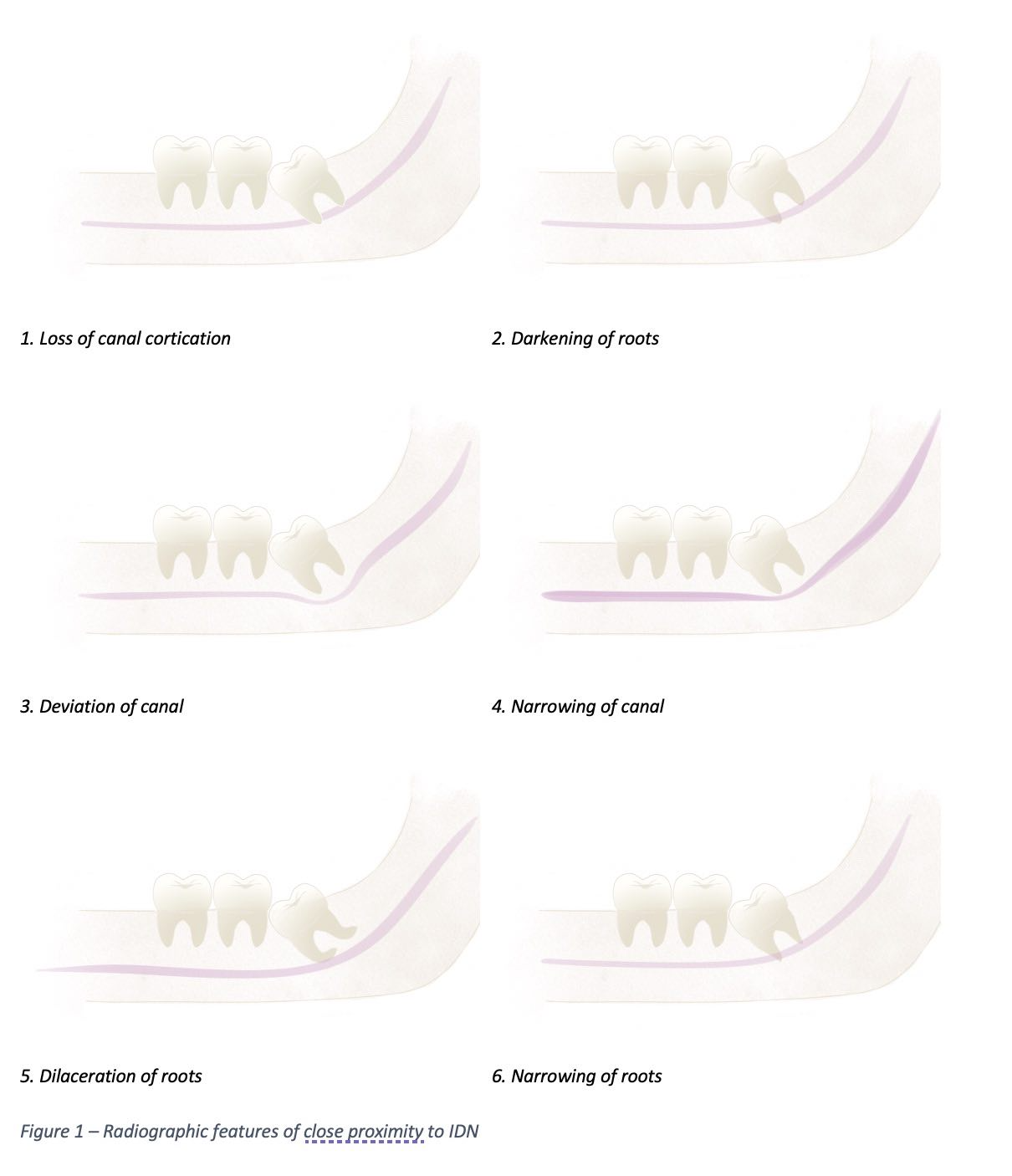 <p>Radiographic Features Suggestive of Close Proximity to the Inferior Dental Canal