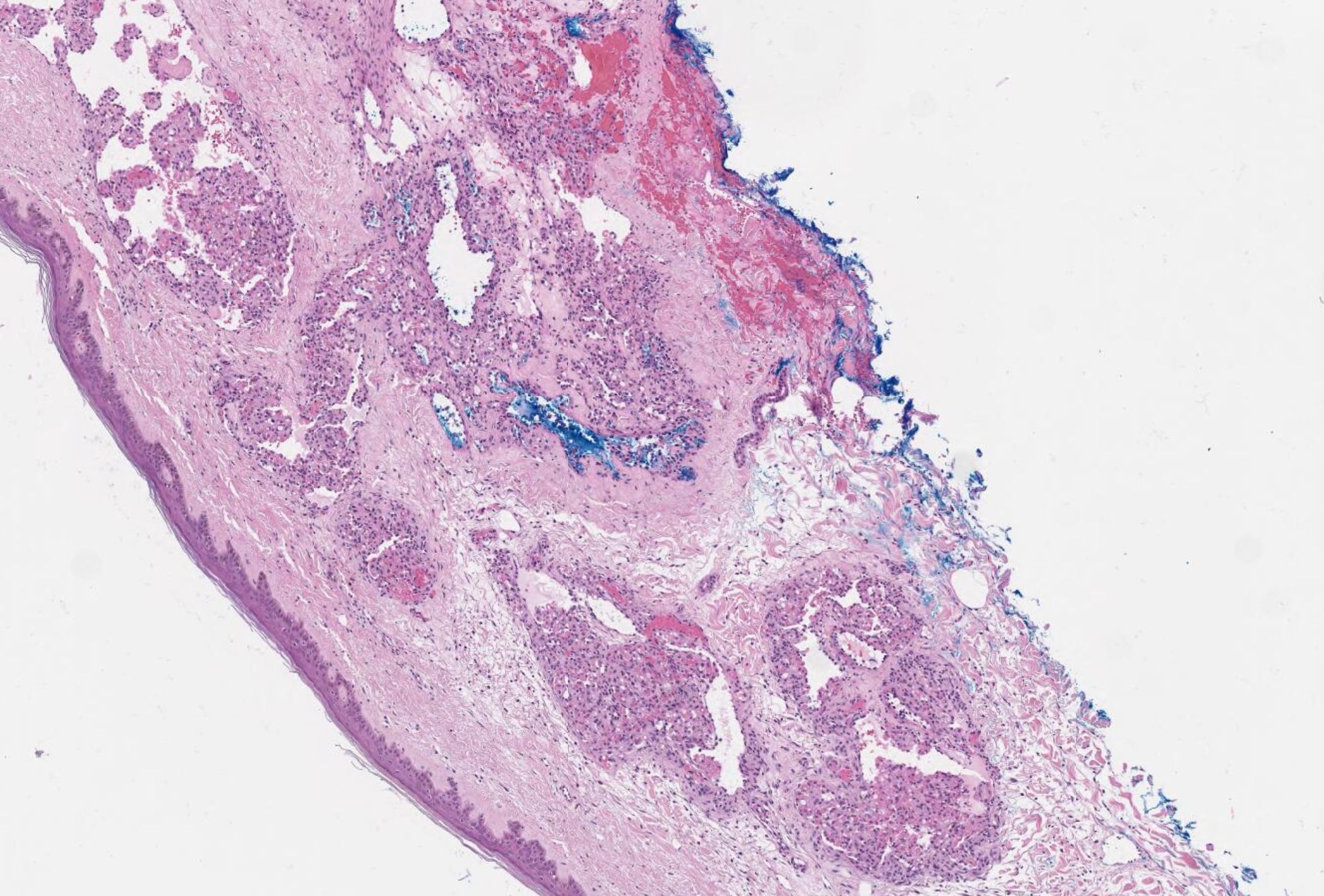 <p>Glomeruloid Hemangioma on Histopathology