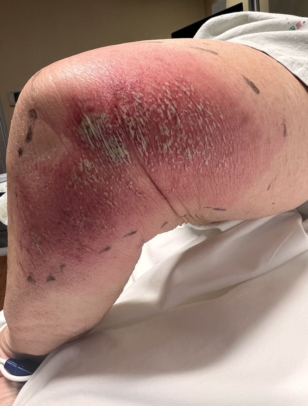 <p>Acute Generalized Exanthematous Pustulosis,&nbsp;Left Lower Limb