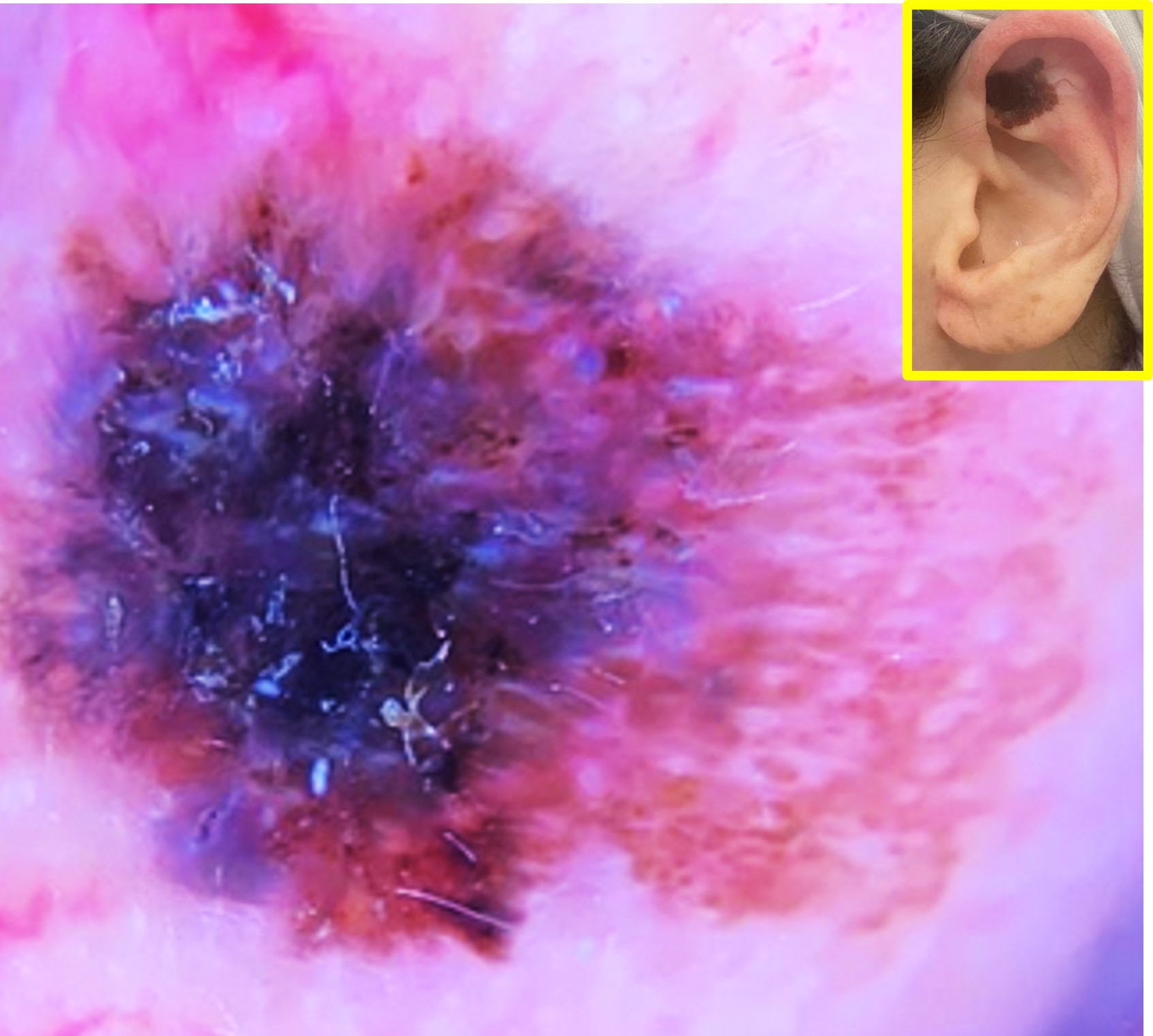 Dermoscopic features of melanoma; a negative pigment network, blue-white veil, shiny white structures, and off-centered blotch