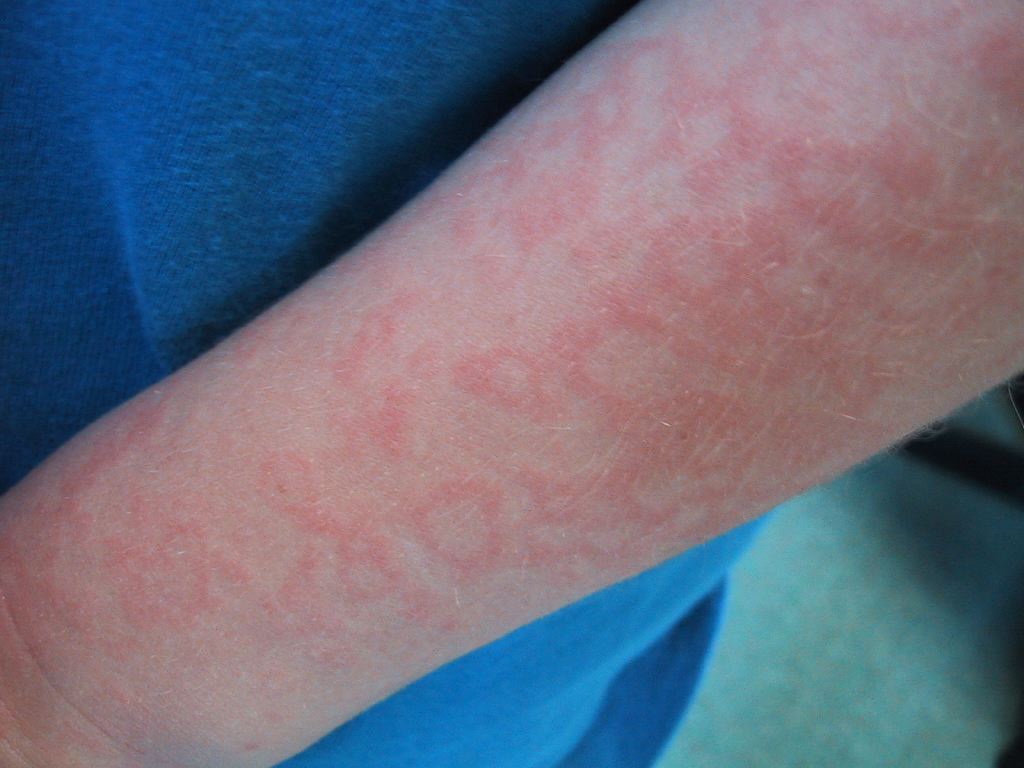 <p>Fifth Disease, Arm Rash