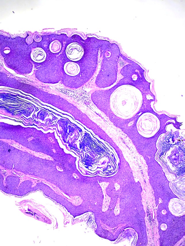 <p>Seborrheic Keratosis