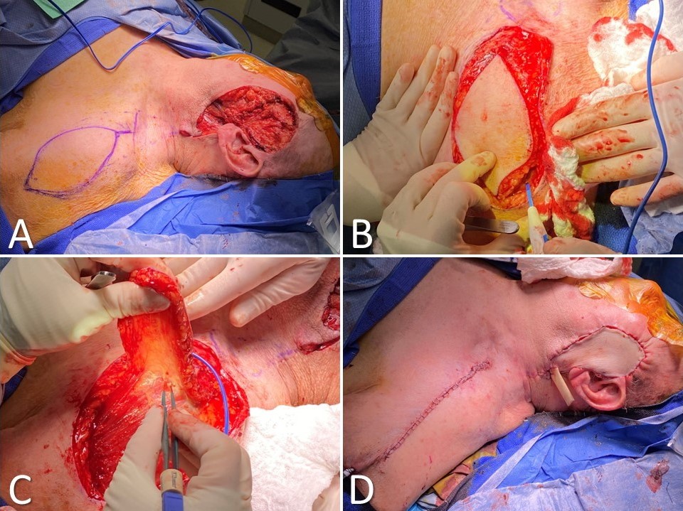 <p>Supraclavicular Artery Island Flap for Facial Reconstruction