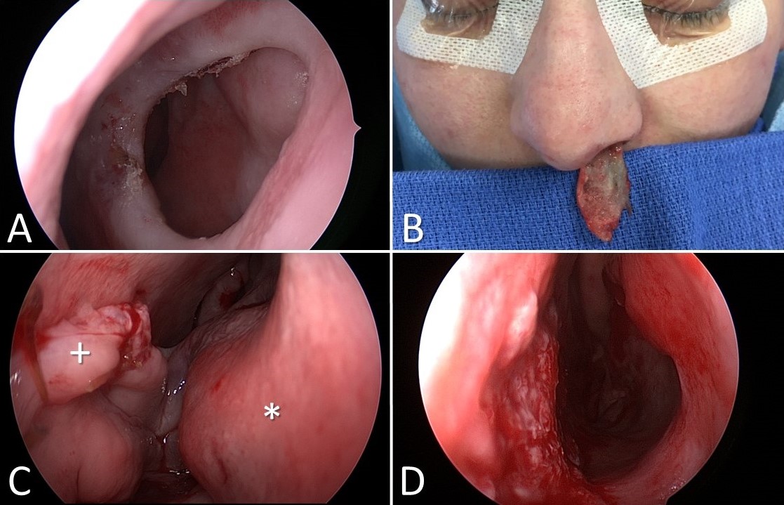 <p>Inferior Turbinate Flap Reconstruction for Nasal Septal Perforation