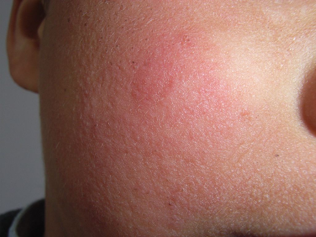 <p>Fifth Disease,&nbsp;Slapped-Cheek Rash