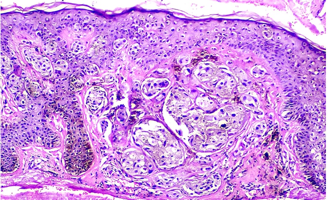 Superficial spreading melanoma in-situ with early invasion (H&E, X100).