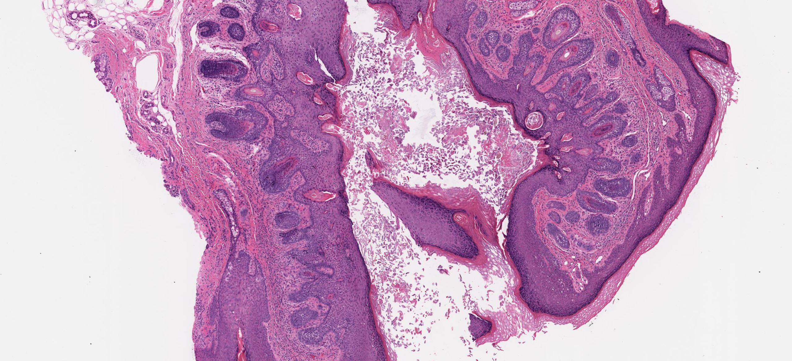 <p>Trichofolliculoma