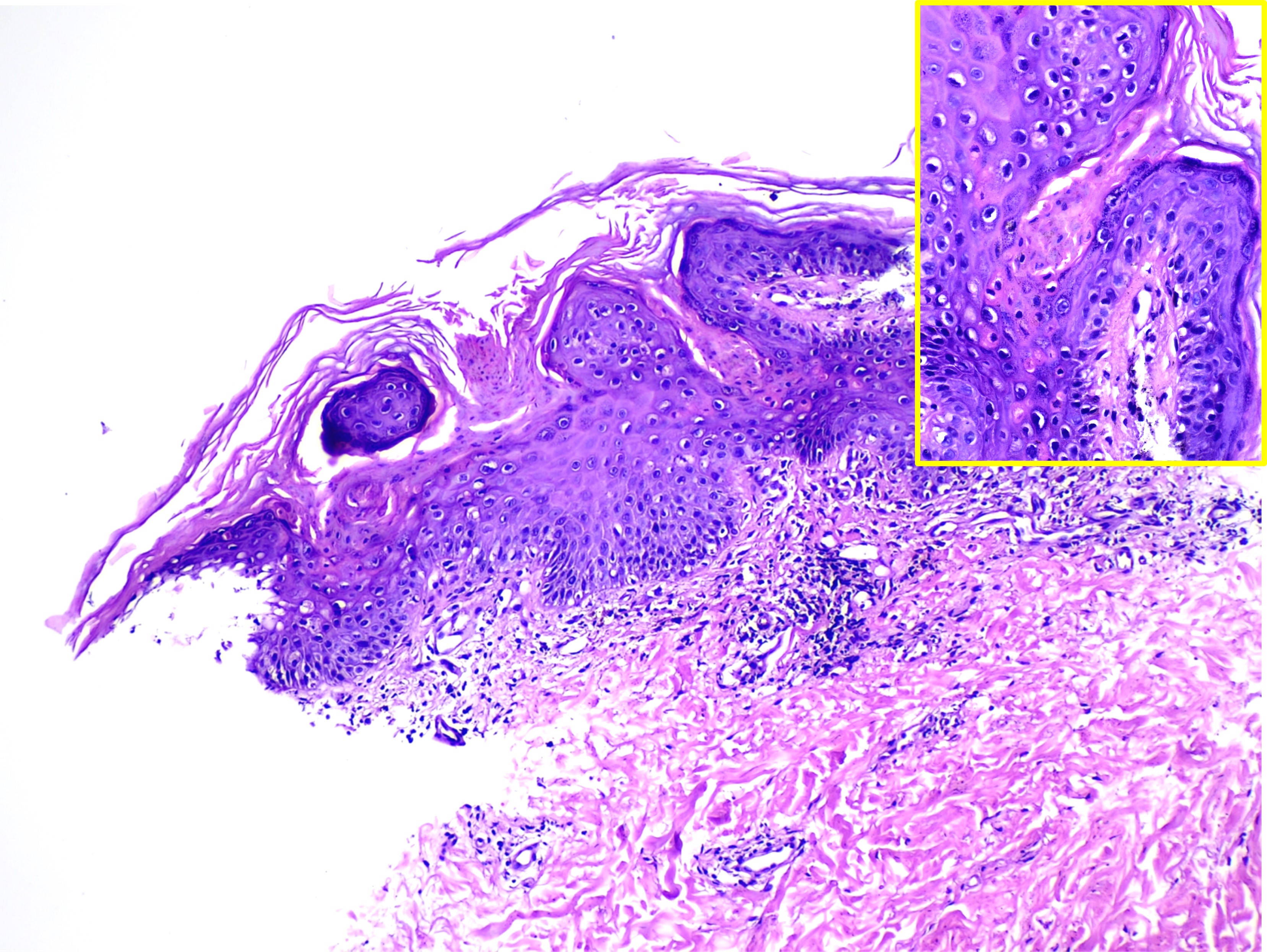 <p>Cornoid Lamellae on Histopathology