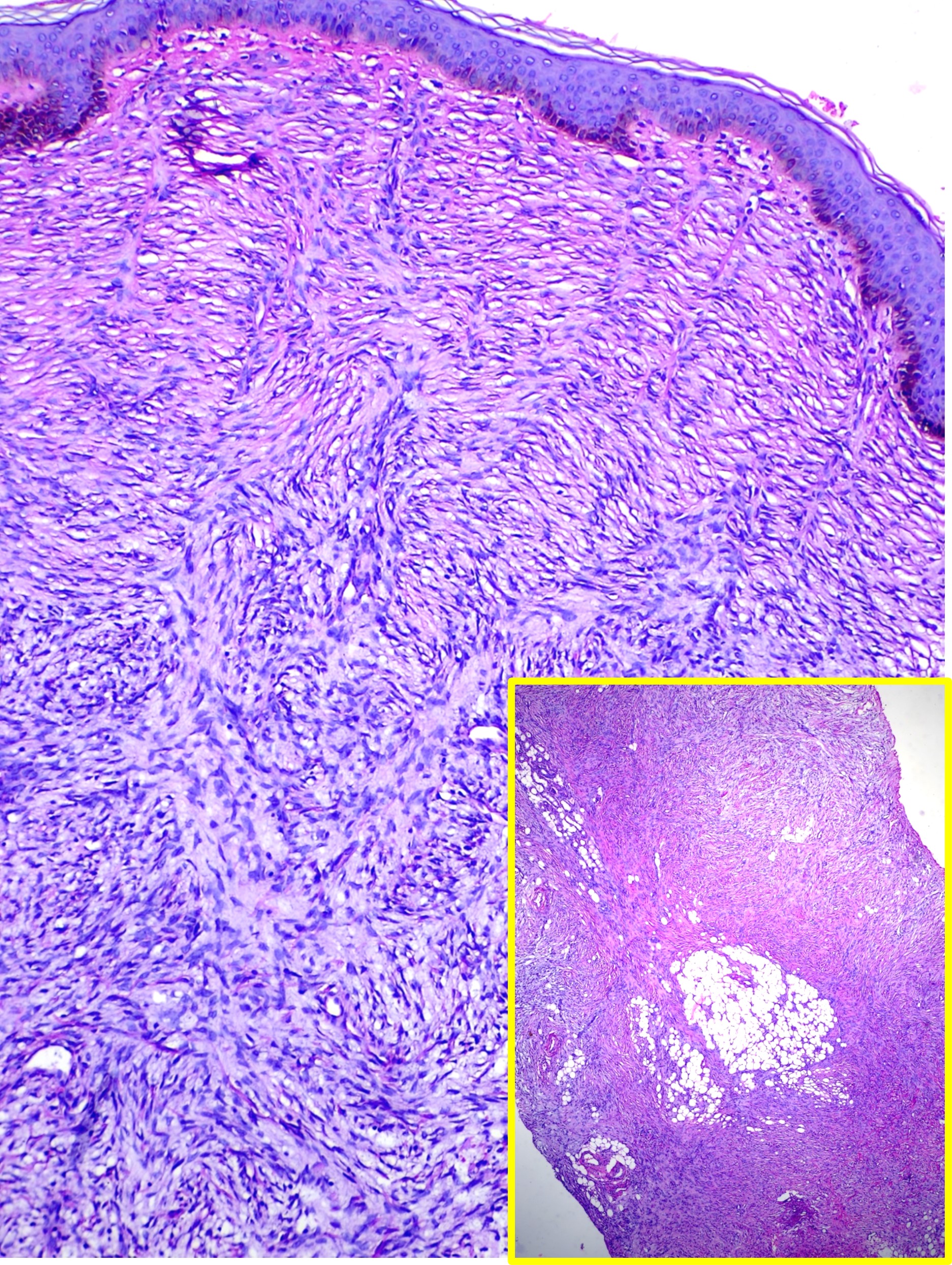 <p>Dermatofibrosarcoma Protuberans