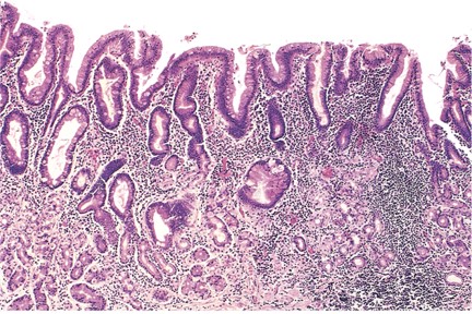 <p>Histopathology of Chronic Gastritis