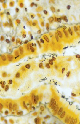 <p><em>Helicobacter pylori</em> Gastritis