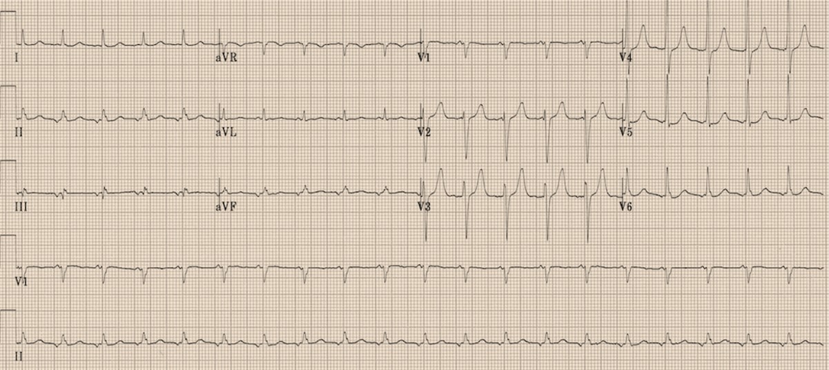 <p>Narrow Complex Tachycardia With Prolonged RP Interval