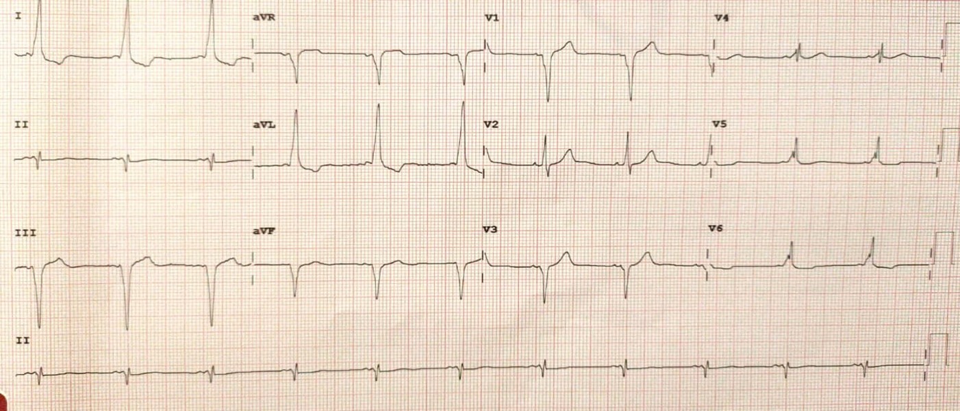 <p>Sinus Rhythm With Short PR Interval and Delta Wave